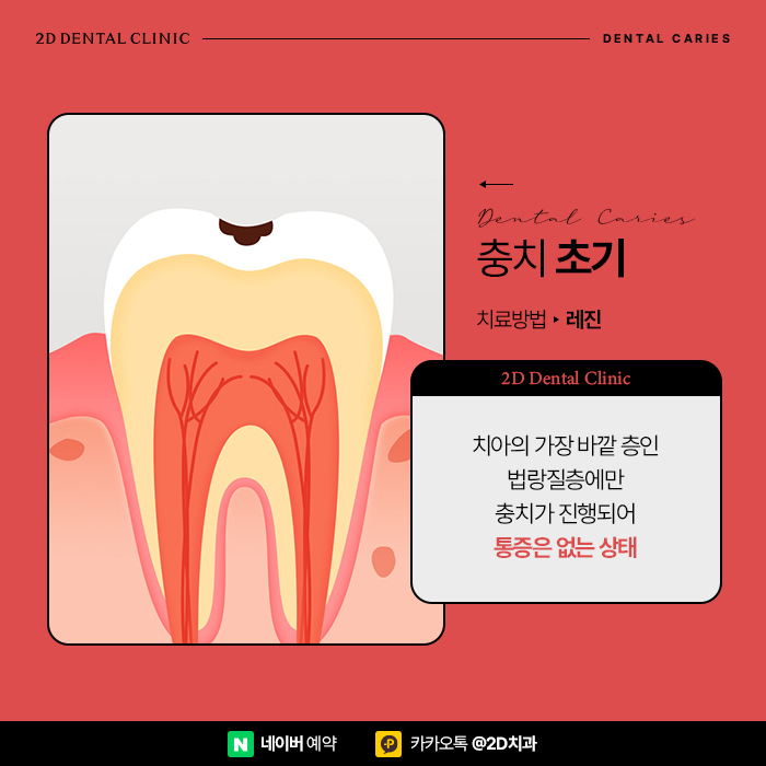 어금니충치치료 빠르게 진행해야 이유, 단계별 레진, 인레이, 크라운 순서 관련 이미지 5