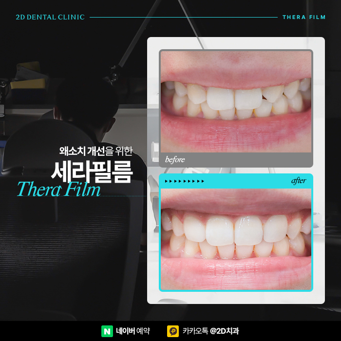 왜소치 세라필름, 원데이라미네이트로 해결하기 위해서는 강남역 치과 관련 이미지 1