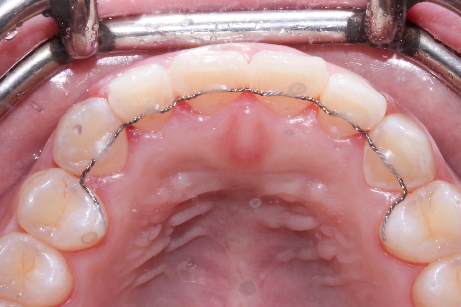옥니교정 방법! 세라믹교정 Case 관련 이미지 12
