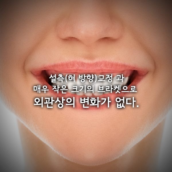 [투디(2D)치과] 2D교정에 대해 아시나요? 관련 이미지 5