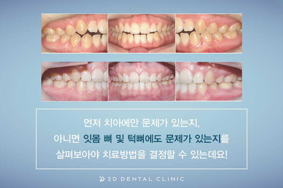 개방교합, 교정으로 잇몸질환 예방하자! 관련 이미지 5