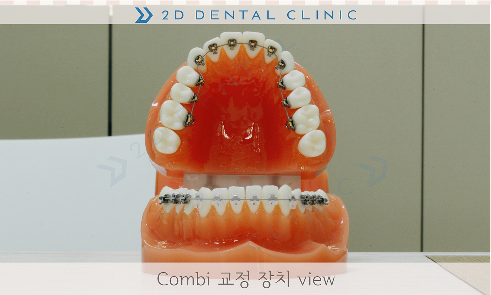 콤비교정, 합리적인 비용으로 돌출입 개선하자! 강남 투디치과 관련 이미지 5