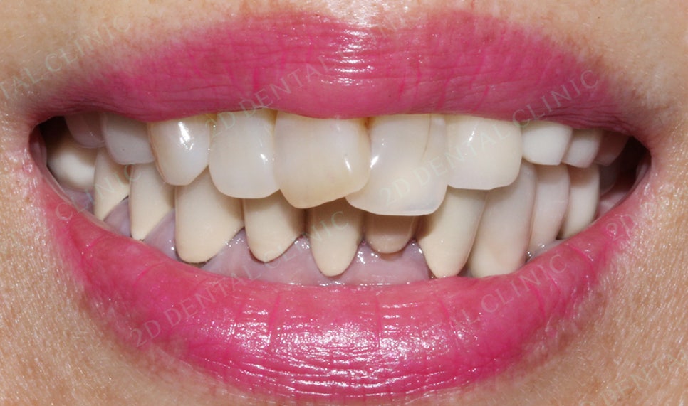 2D치과(투디치과) 교정일기 ㅣ 잇몸질환 예방되는 치아교정(feat.어머님교정) 관련 이미지 4