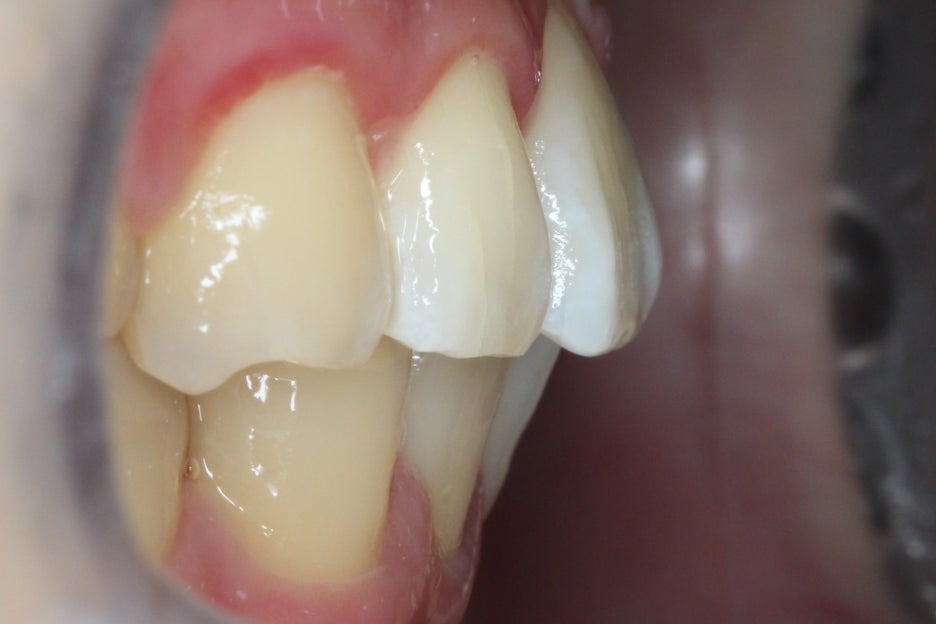 논현동치과 윗니부분교정 후기 관련 이미지 9