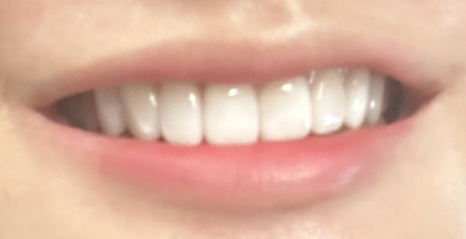 무삭제라미네이트 치아삭제없는 0.1mm 얇은 블랙필름 관련 이미지 3