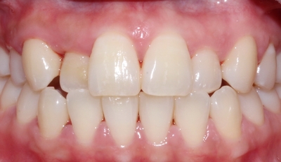 6개월 부분교정. 더이상 망설이지 마세요! 관련 이미지 2