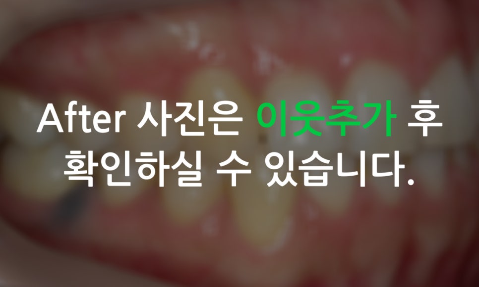 덧니교정 2D교정 (부분교정) 후기 관련 이미지 11