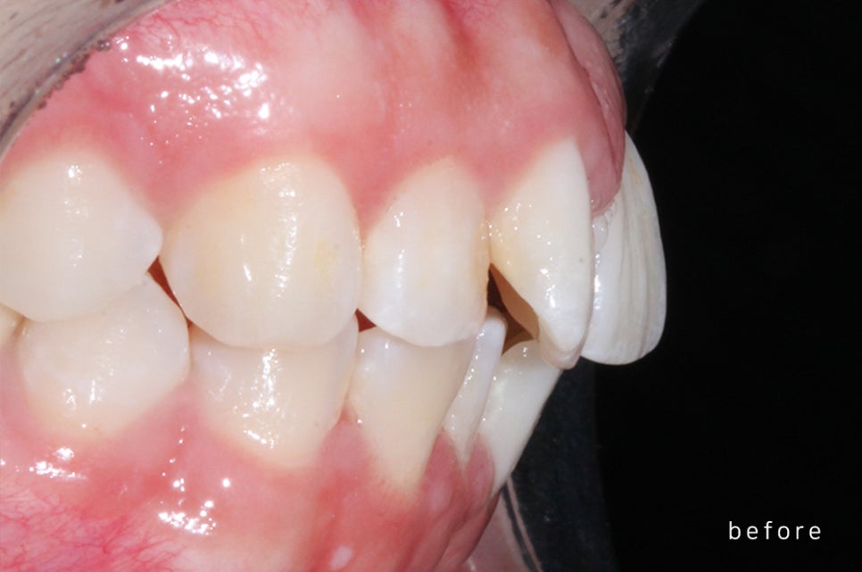 [돌출입 무턱] 안모교정 진행중! by.투디치과(투디치과)전체교정 관련 이미지 4