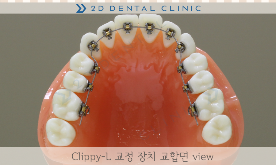 [교정상식] 설측교정,투명교정,콤비교정 장치종류 및 장단점! 관련 이미지 4
