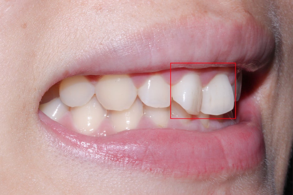 옥니교정 방법! 세라믹교정 Case 관련 이미지 2