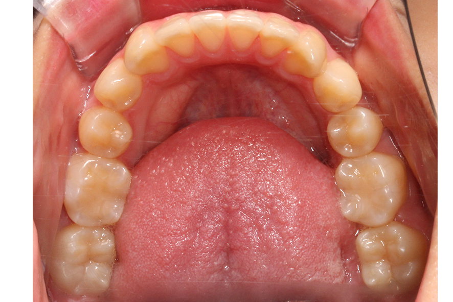 입돌출 데이몬교정 Case1 관련 이미지 7