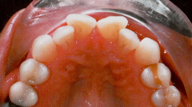 나비치아, 앞니 부분 2D교정으로 교정 기간 단축! 관련 이미지 3