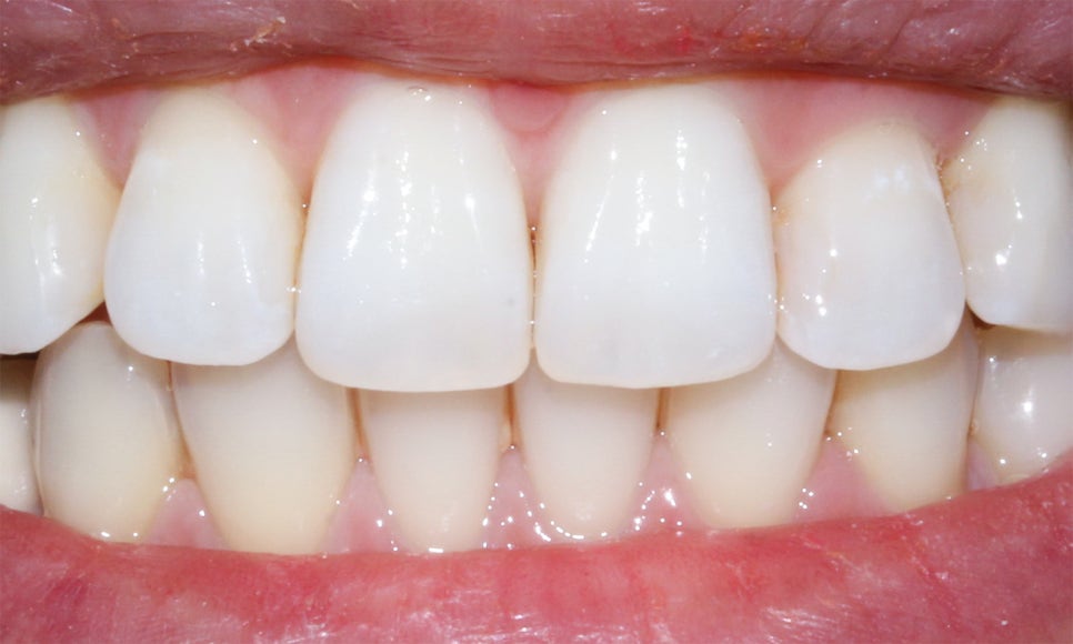 토끼 이빨 치아교정 5개월 교정 완료! by. 투디치과(2D치과) 관련 이미지 10