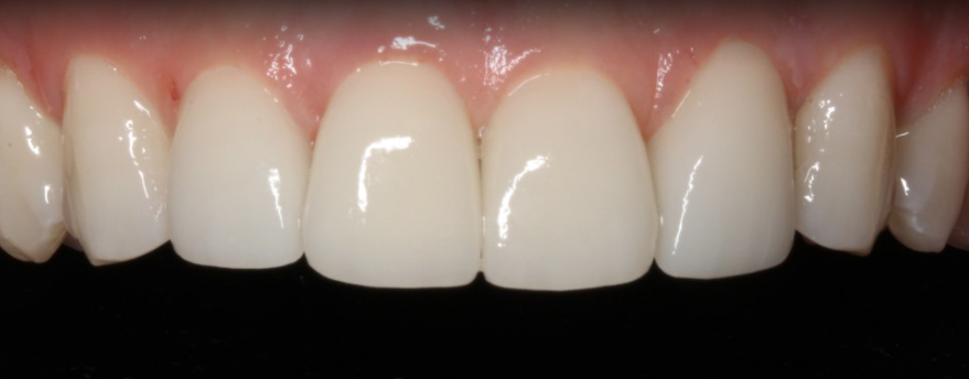 강남라미네이트병원 치아삭제 없는 무삭제치아성형 블랙필름 관련 이미지 4