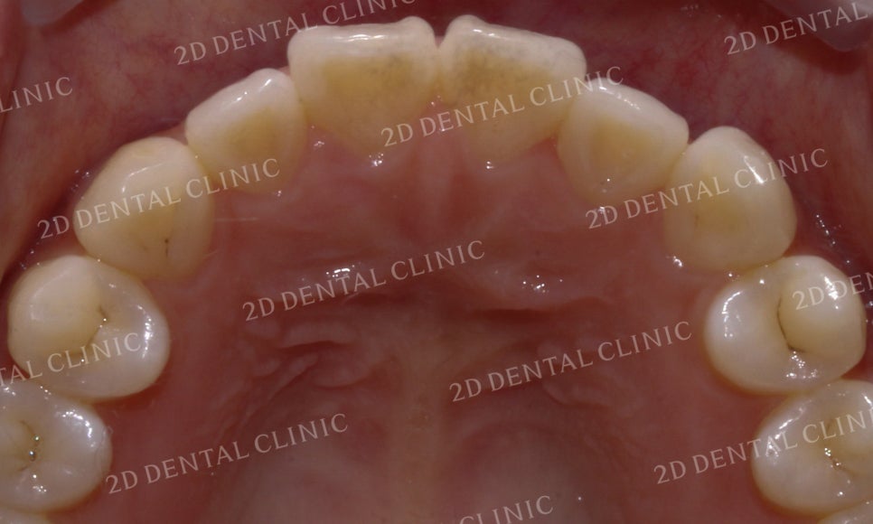 [앞니교정]토끼앞니교정, 부분교정으로 토끼이빨 탈출하기! by.투디치과(2D치과) 관련 이미지 5
