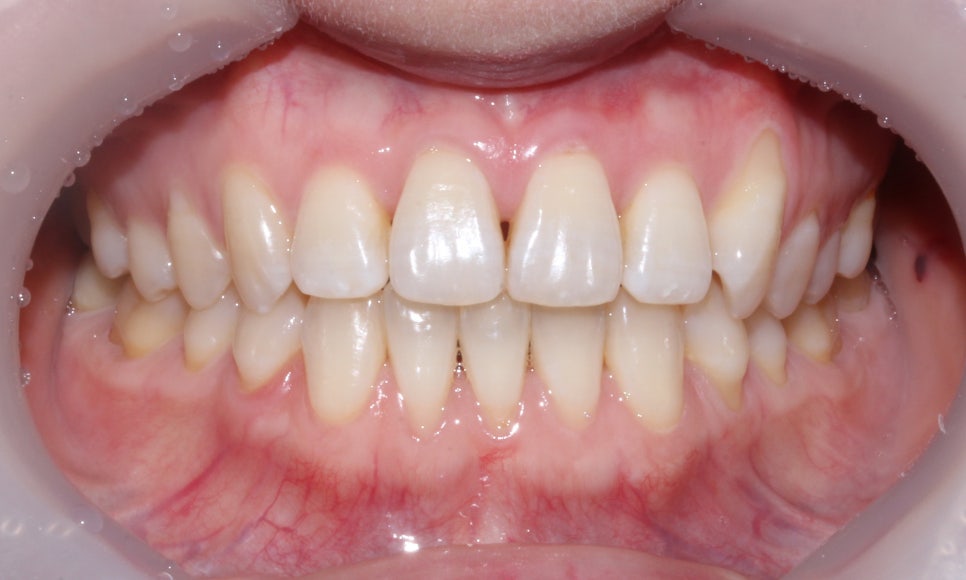 나비치아 교정 케이스 전후비교, 교정전문 2D치과 관련 이미지 8