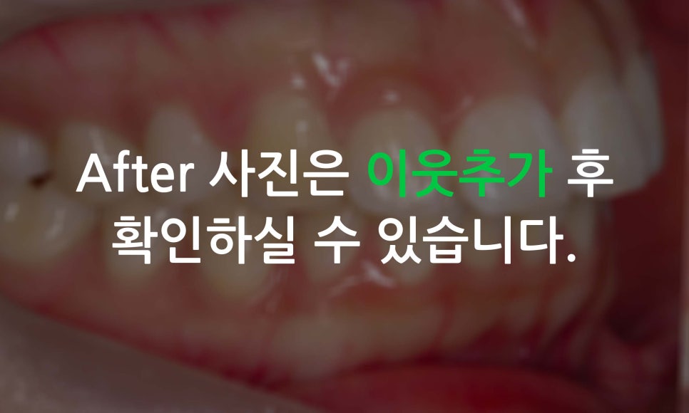 앞니틀어짐, 삐뚤어진 앞니를 부분교정하는 방법 관련 이미지 10