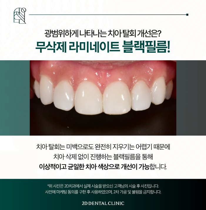 광주무삭제라미네이트 블랙필름으로 치아 반점 개선하기 관련 이미지 4
