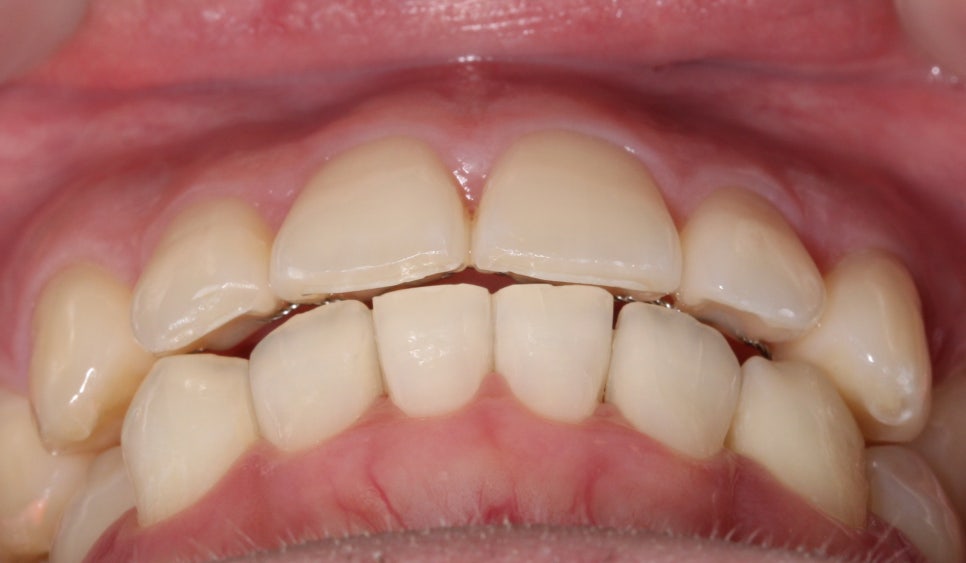 부분교정으로 삐뚤어진 앞니 예뻐지는 방법 관련 이미지 18