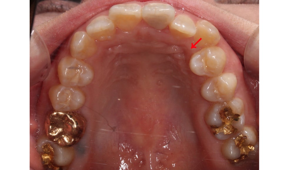 양악교정 송곳니교정 중심으로 관련 이미지 6