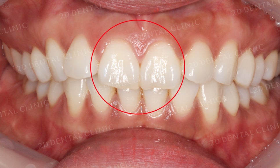 [부분교정] 틀어진 앞니, 부분교정으로 앞니교정하기! by.투디치과(2D치과) 관련 이미지 5
