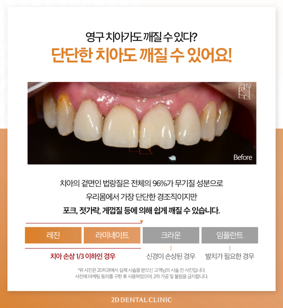 부산무삭제라미네이트 영구치앞니깨짐 어떻게 해야 좋을까요? 관련 이미지 3