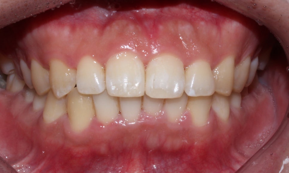 뻐드렁니 교정, 강남역치과에서 앞니 부분 교정한 후기! 관련 이미지 11