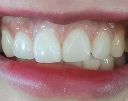 치아성형 잇몸성형 치아삭제 없는 무삭제라미네이트 블랙필름 관련 이미지 5