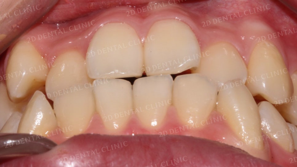 덧니치아교정, 클리피씨 전체교정으로 완벽하게! by.투디치과(2D치과) 관련 이미지 3