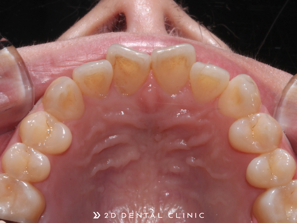 나비치아, 앞니 부분 2D교정으로 교정 기간 단축! 관련 이미지 10