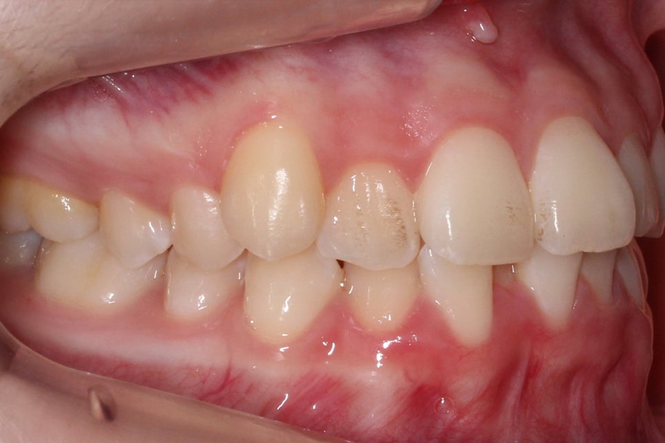 투디치과 송곳니덧니 치료 후기 관련 이미지 4