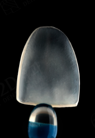 앞니 무삭제라미네이트 고객맞춤형 치아제작하는 블랙필름 관련 이미지 6