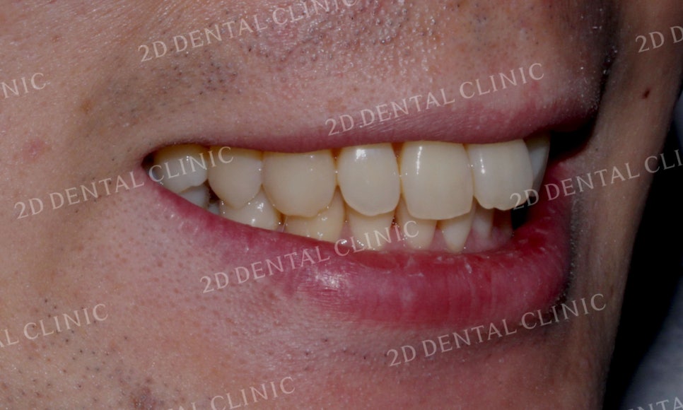[투디교정] 부정교합 앞니교정을 투디교정으로 고르게! by.투디치과(2D치과) 관련 이미지 4