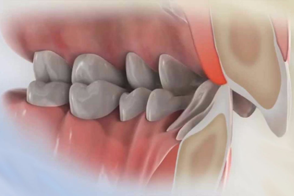과개교합 케이스도 2D치과에서 해결! 관련 이미지 4