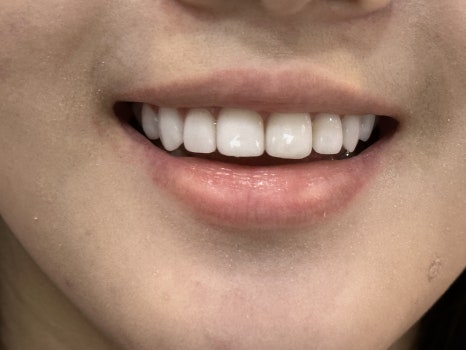 무삭제 라미네이트 개인의 치아디자인에 맞춘 단 하나밖에 없는 치아디자인 블랙필름 관련 이미지 7