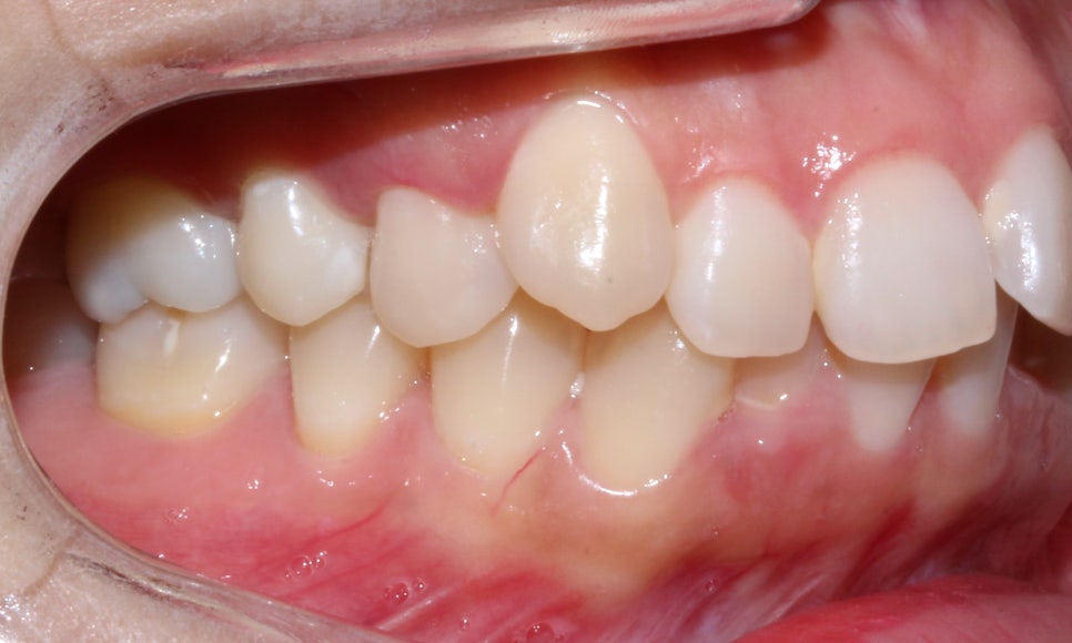 돌출입 탈출기! 덧니 교정도 문제없어! by.투디치과(2D치과) 관련 이미지 8