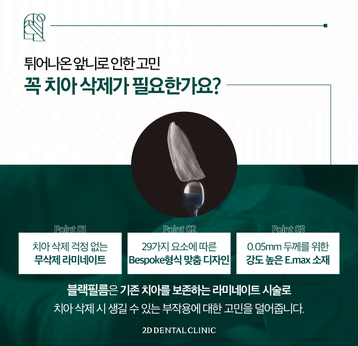 무삭제라미네이트가격 토끼 앞니도 개선이 되나요? 관련 이미지 4