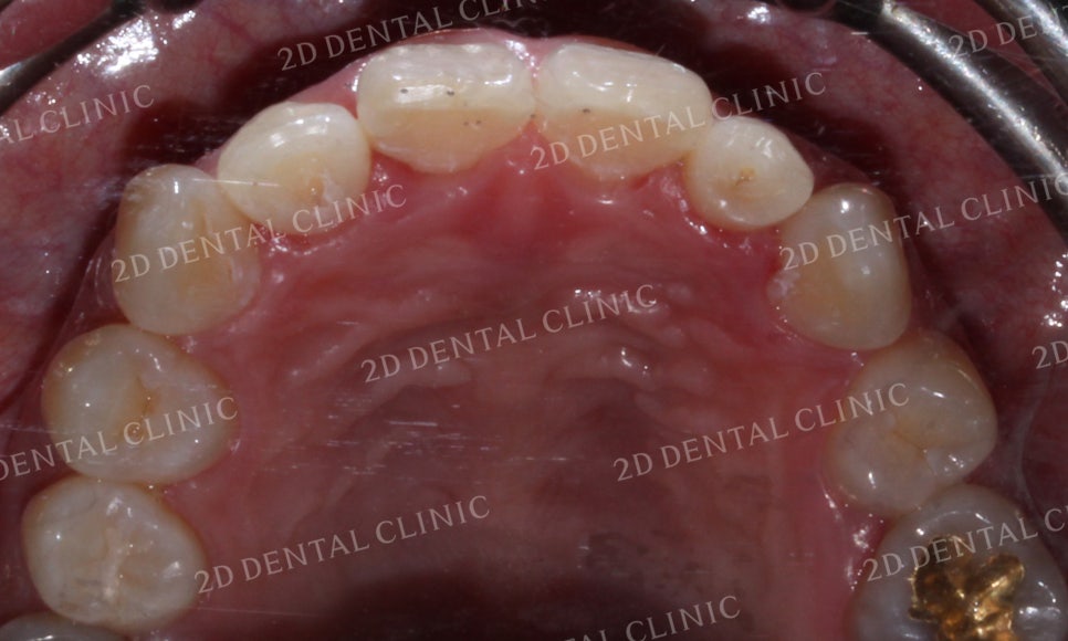 나비치아교정, 부분교정으로 나비치아 탈출하기! by.투디치과(2D치과) 관련 이미지 17