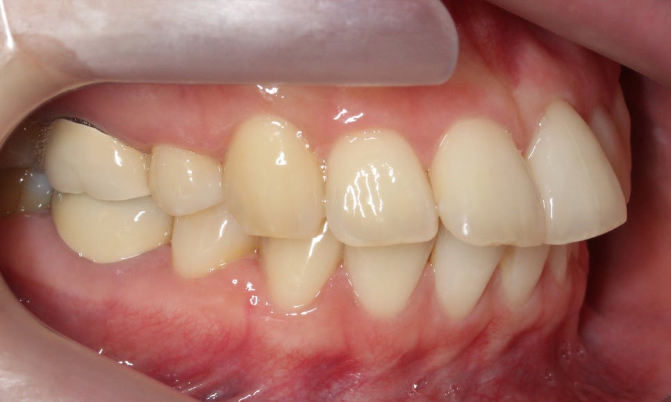 대치동치과 입툭튀 집어넣는 교정 관련 이미지 4