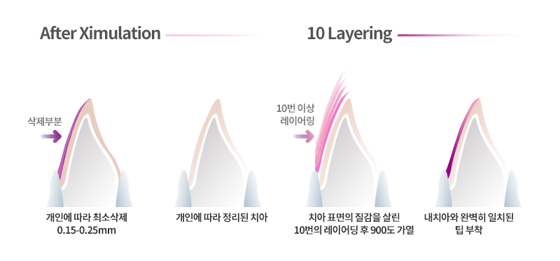 블링스 라미네이트의 치아 최소 삭제는? 관련 이미지 2