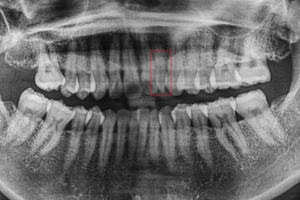 왜소치 뻐드렁니 교정 신논현역치과에서 관련 이미지 5