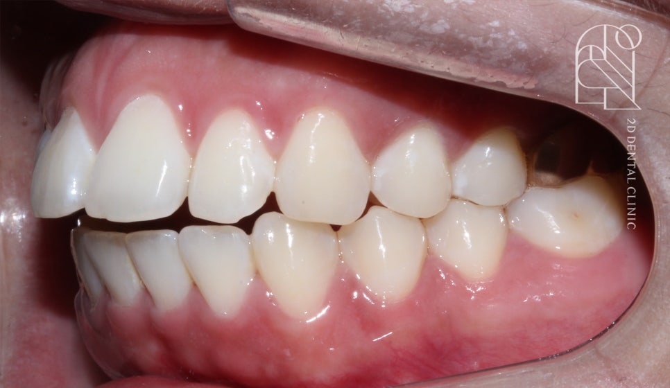 부정교합 치아교정, 전체교정으로 완성하기! by. 투디치과(2D치과) 관련 이미지 5