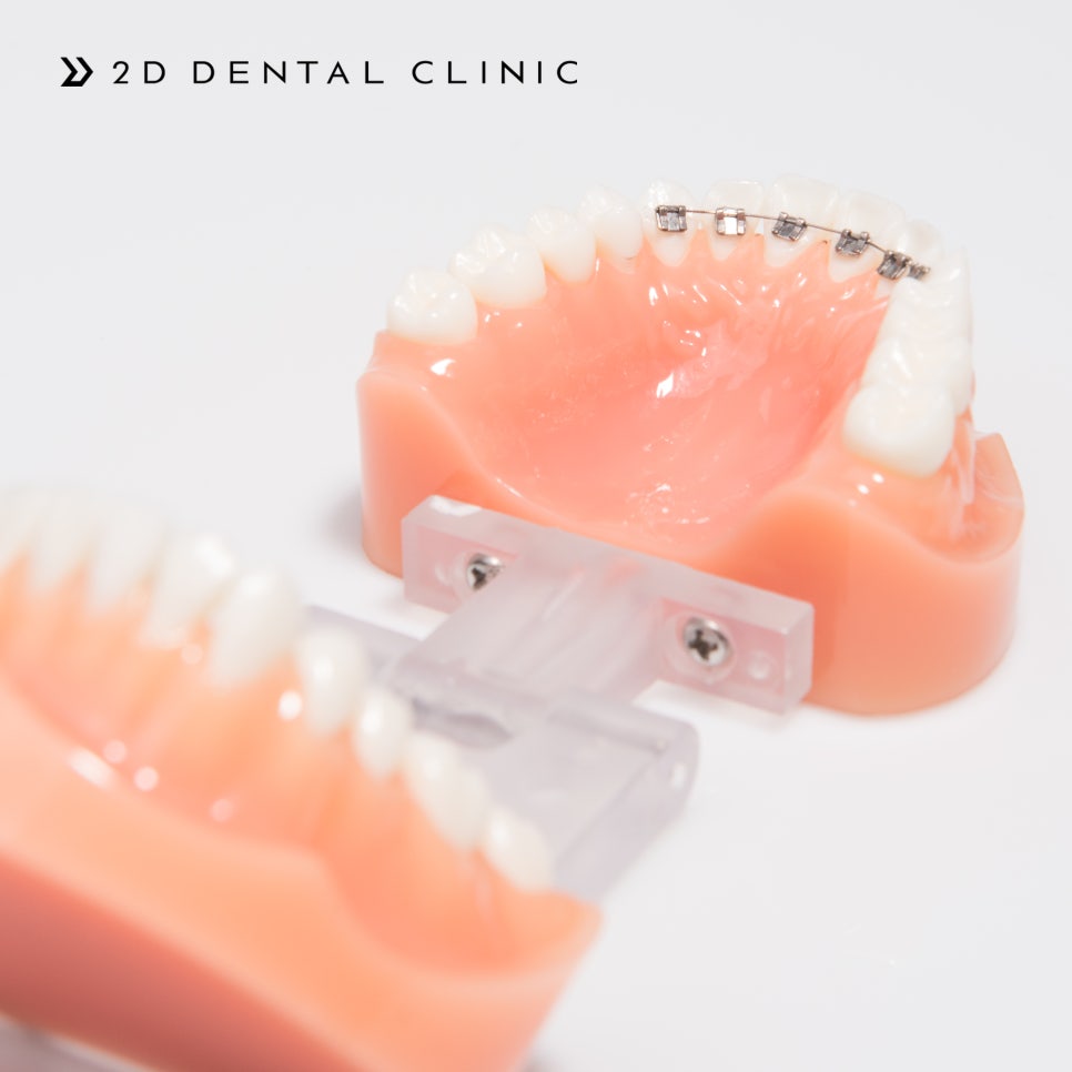 방학기간 동안 대학생을 위한 앞니 부분교정 종류 관련 이미지 8