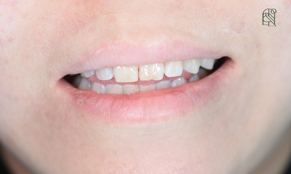 벌어진 앞니, 앞니벌어짐(diastema) 치료 - 레진, 교정, 라미네이트 관련 이미지 8