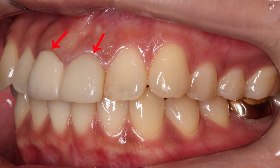 토끼앞니교정, PFM크라운 재보철을 동시에 치료하는 방법? 관련 이미지 5