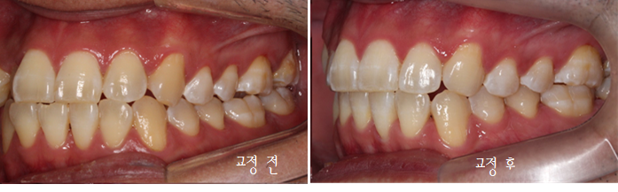 앞니 덧니 고민, 부분 설측 교정으로 해결한 사례 관련 이미지 19