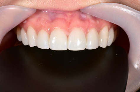 블랙필름 치아 삭제없는 무삭제라미네이트 후기 관련 이미지 7