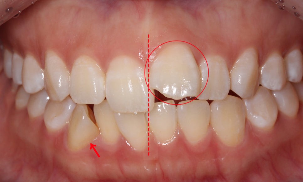 앞니돌출 급속교정 Case feat. 2D교정 관련 이미지 1