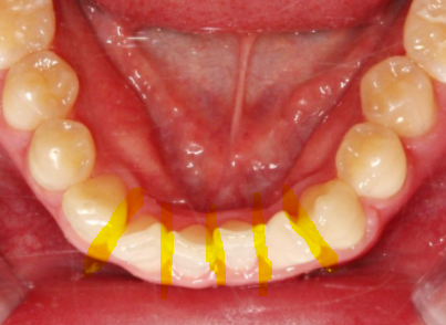 부분교정으로 삐뚤어진 앞니 예뻐지는 방법 관련 이미지 13