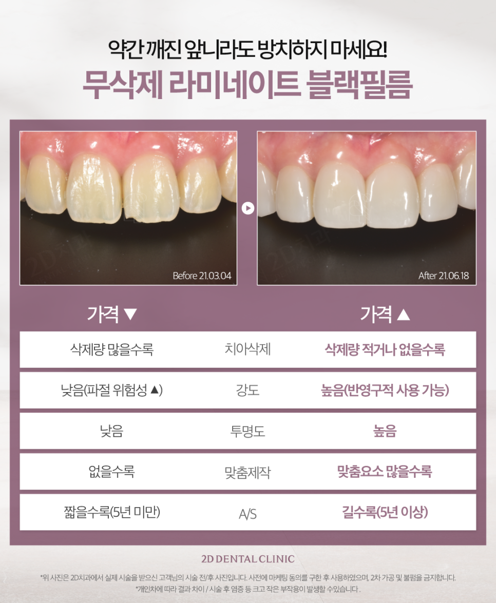 무삭제라미네이트비용 앞니살짝깨짐 더욱 큰 손상을 막기 위해서 관련 이미지 6